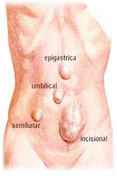 Hernia Photos